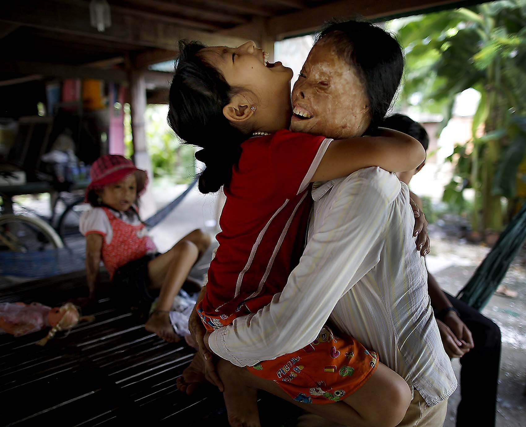 Acid survivor hugging a child