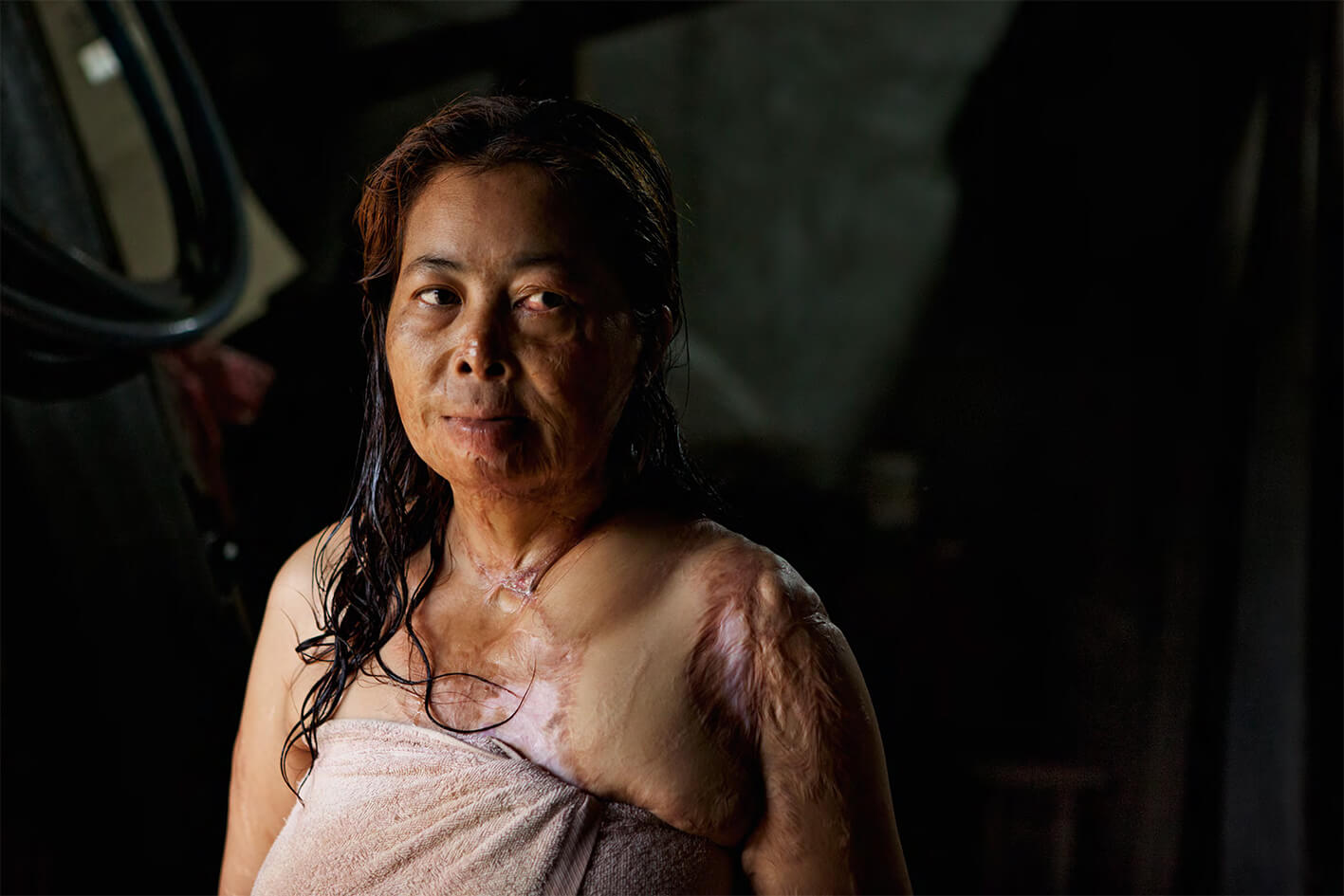 Acid survivor Chantheoun standing in her home