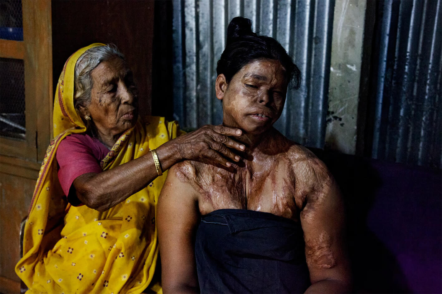 Acid survivor Farida being massaged by her mother 